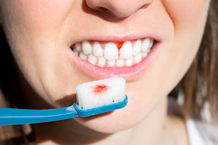 Five Possible Reasons For Your Bleeding Gums