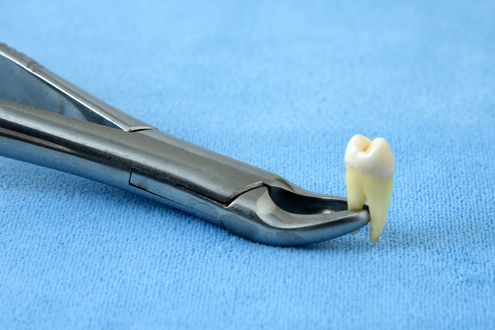 When to Stop Using Gauze After a Tooth Extraction