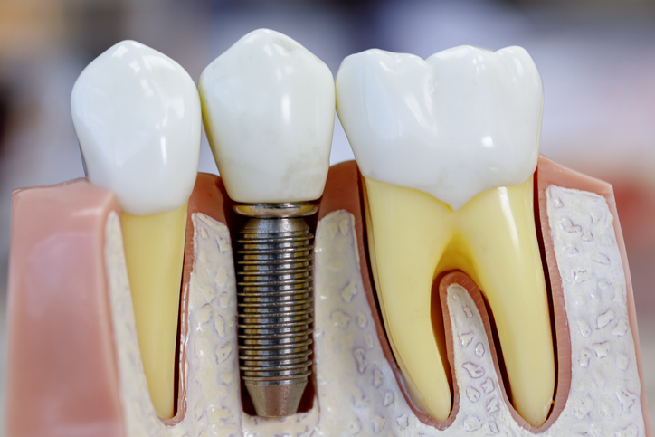 Can Dental Implant Stop Bone Loss?
