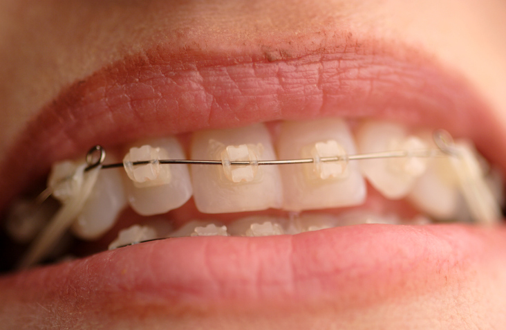 How Do Swollen Gums with Braces Impact Your Oral Health?