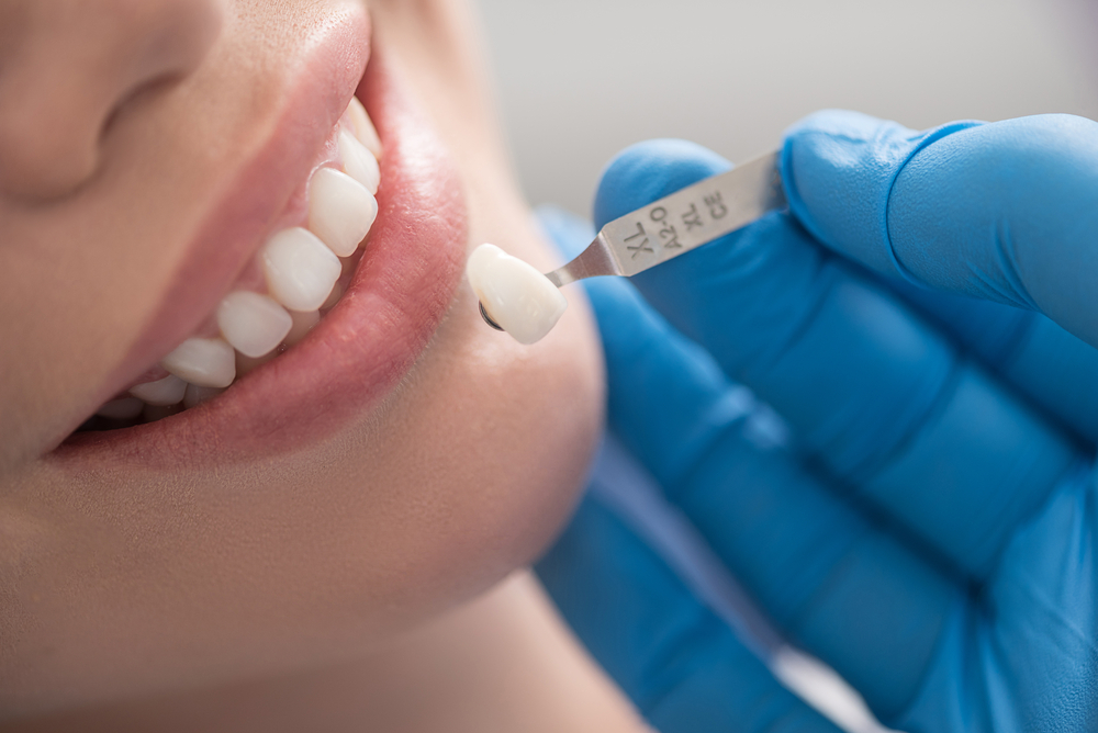 What To Do if You've Lost a Dental Crown