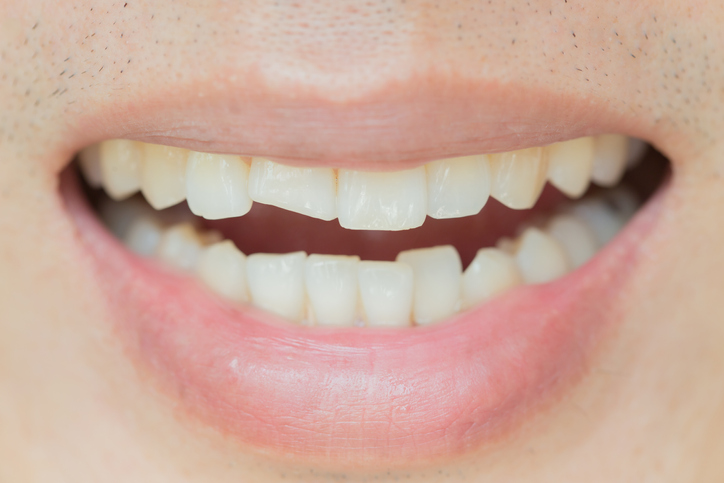How Do You Fix a Cracked Front Tooth?