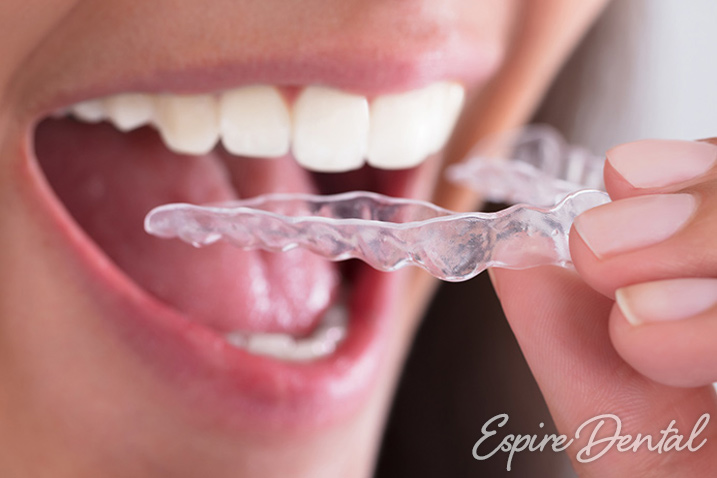 Invisalign For Perfect Teeth At Your Wedding Espire Dental Co 