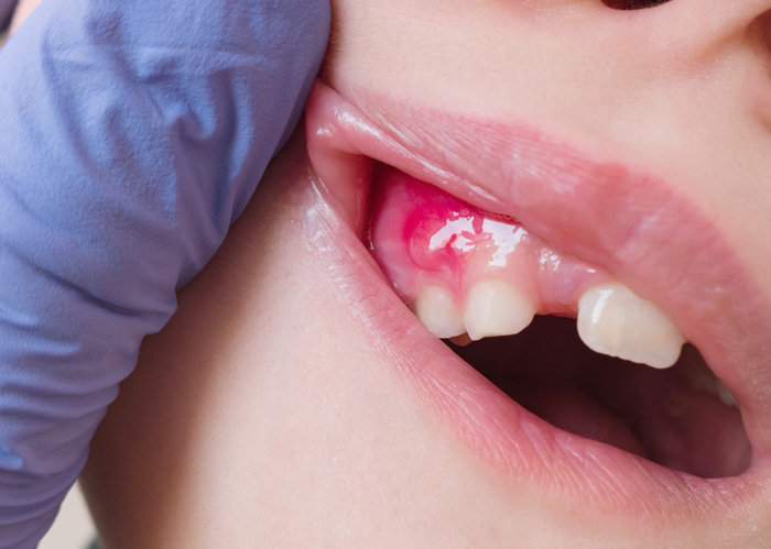 Everything You Need to Know About Gum Abscess Treatment