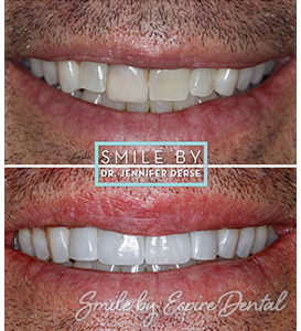 Before and after of cosmetic dentistry