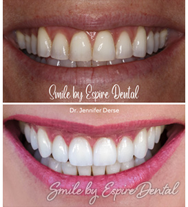 Before and after of cosmetic dentistry