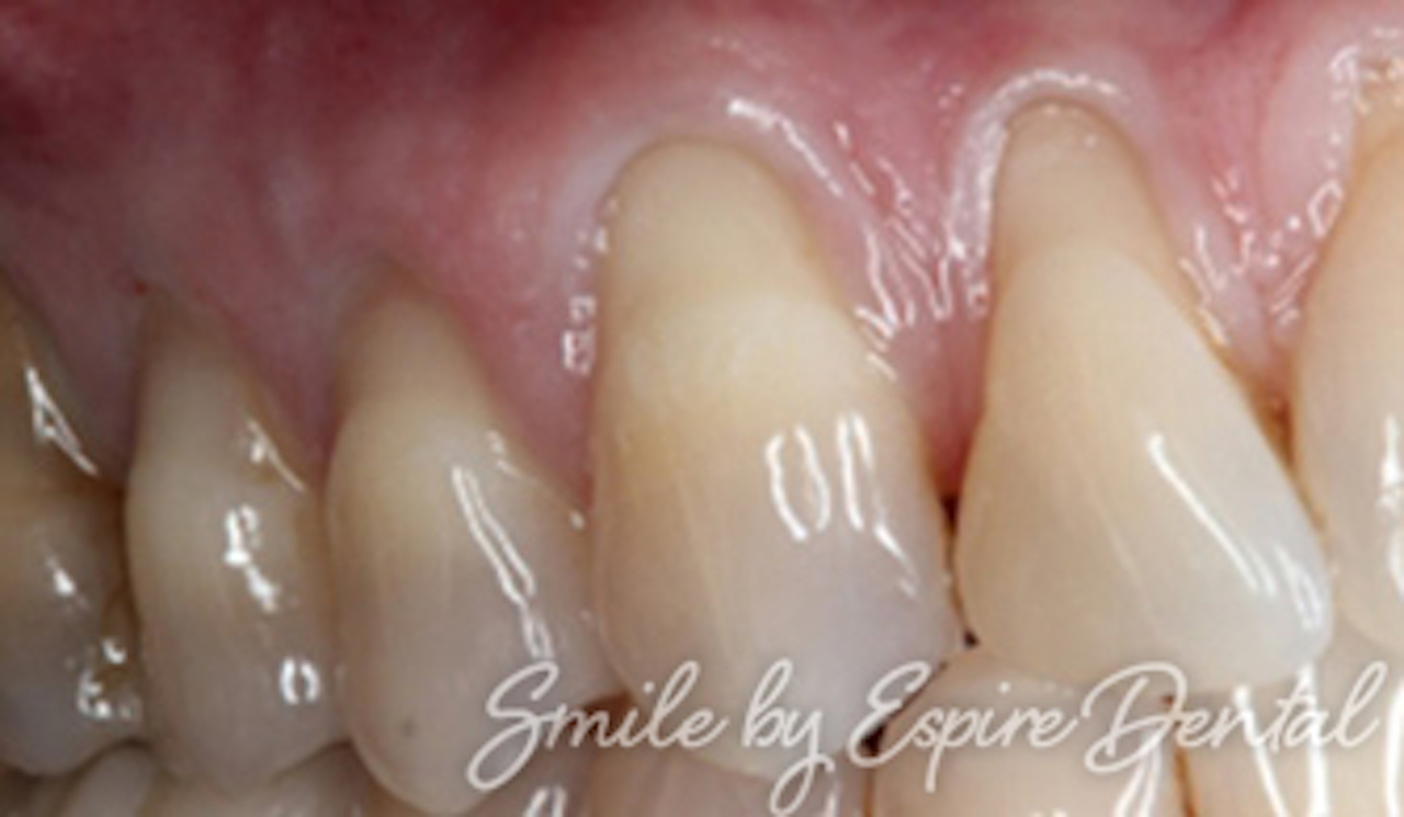 periodontal tissue graft 1