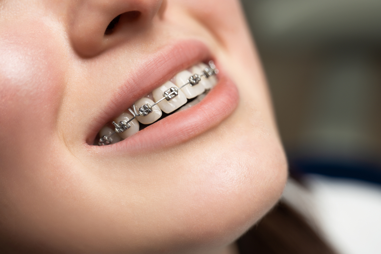 close-up of woman with braces