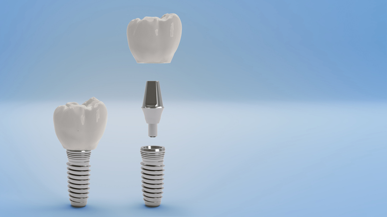 Here's What You Need To Know About Dental Implant Recovery
